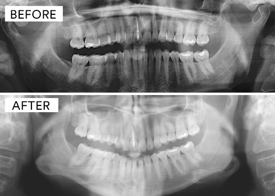 Before and after showing straight teeth