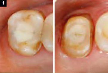 Tooth close-up of inital situation