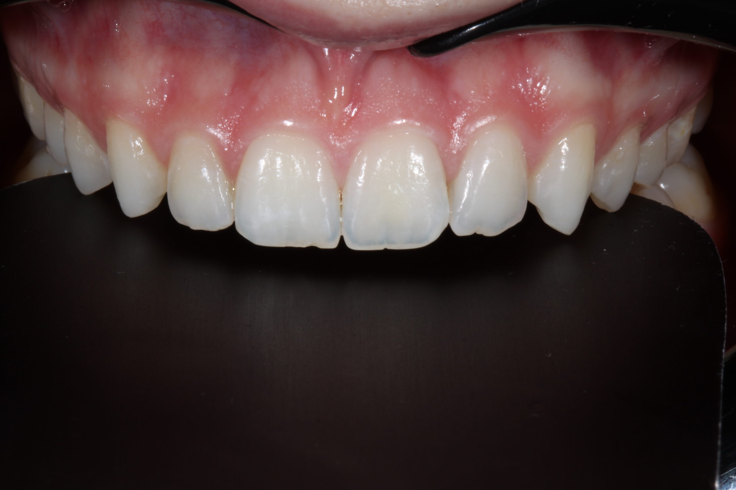 Buccal view.  Anatomy of front teeth.