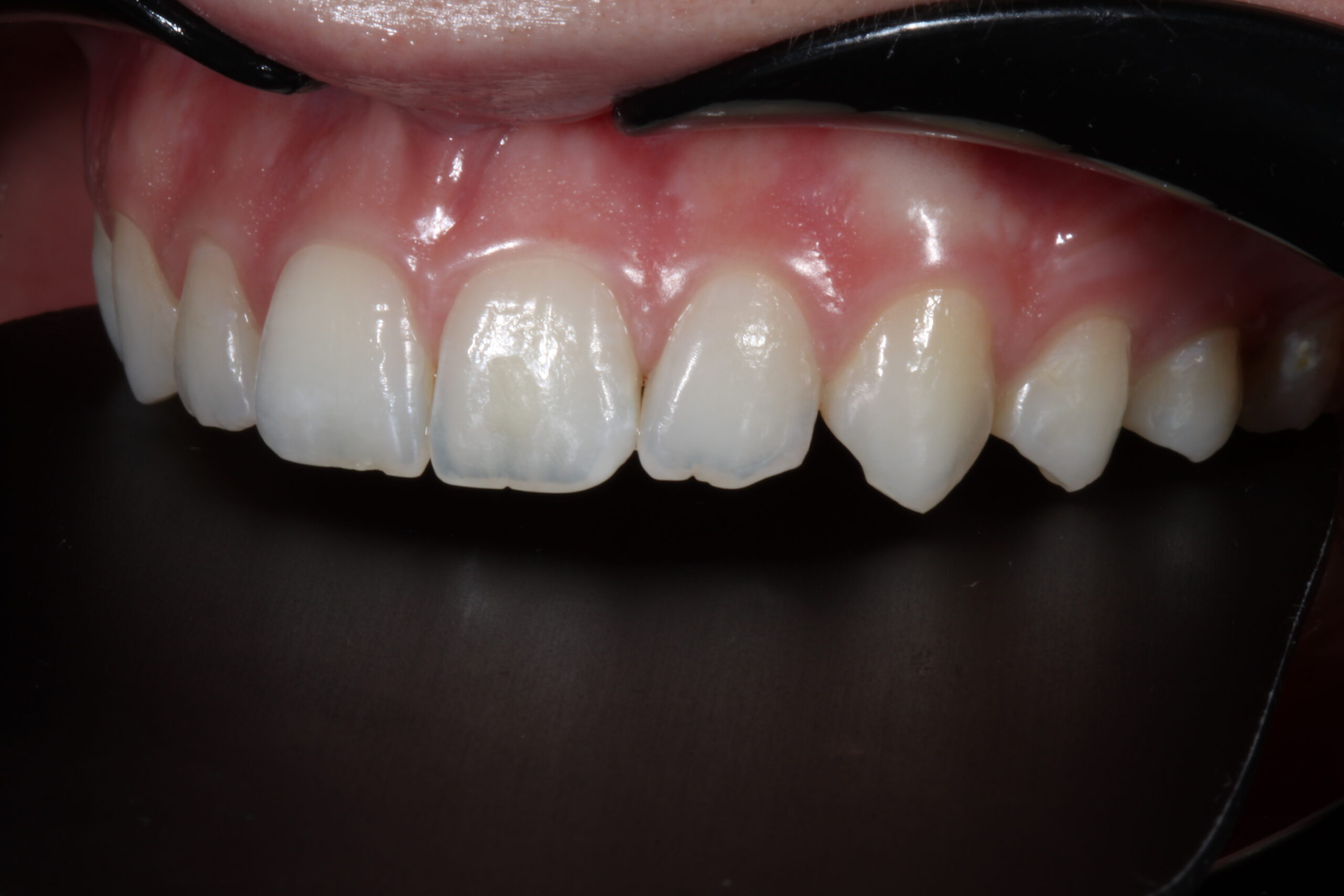 Buccal view. Anatomy of #22 and 23.