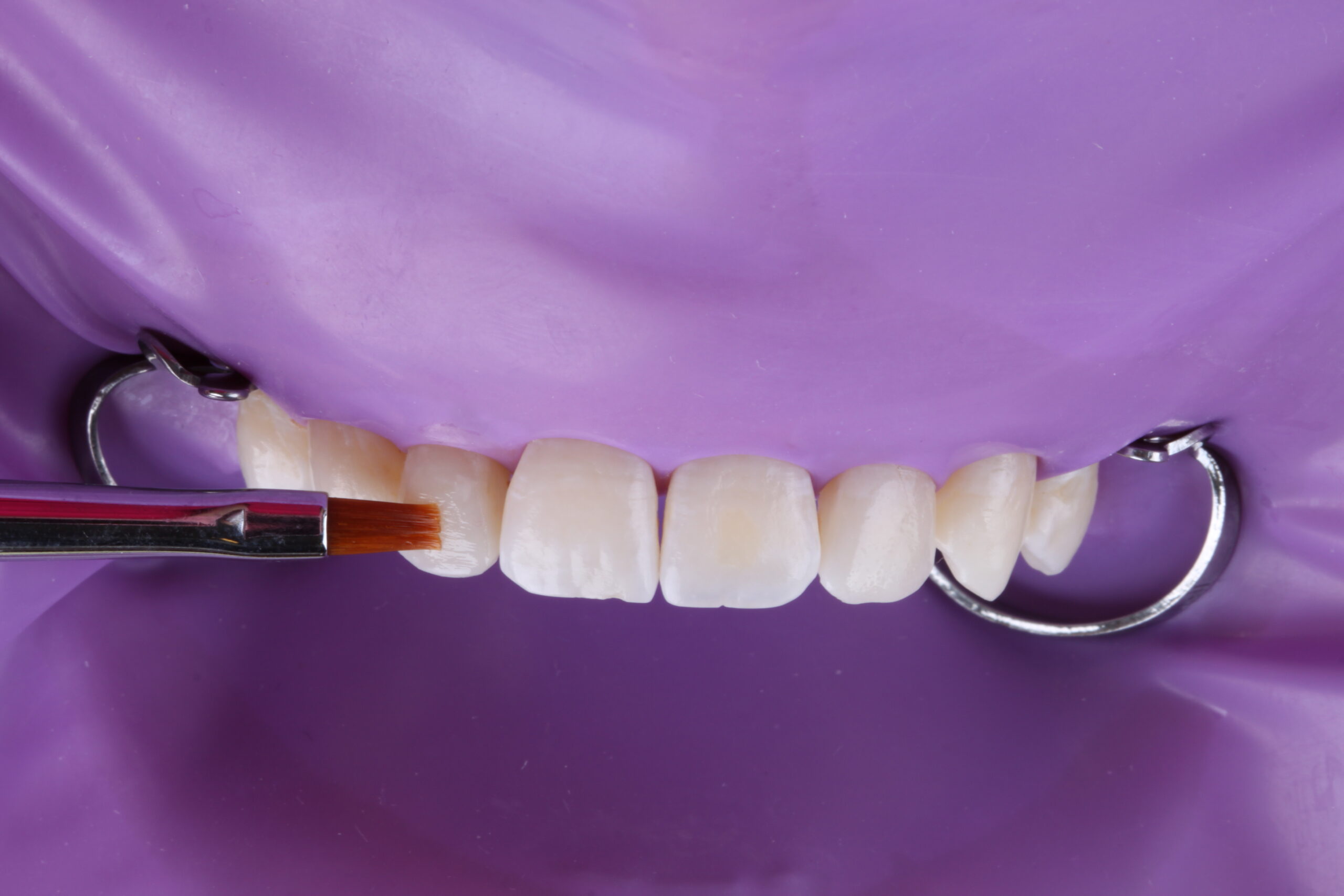 Brush helps with shape and composite blend on tooth surface.