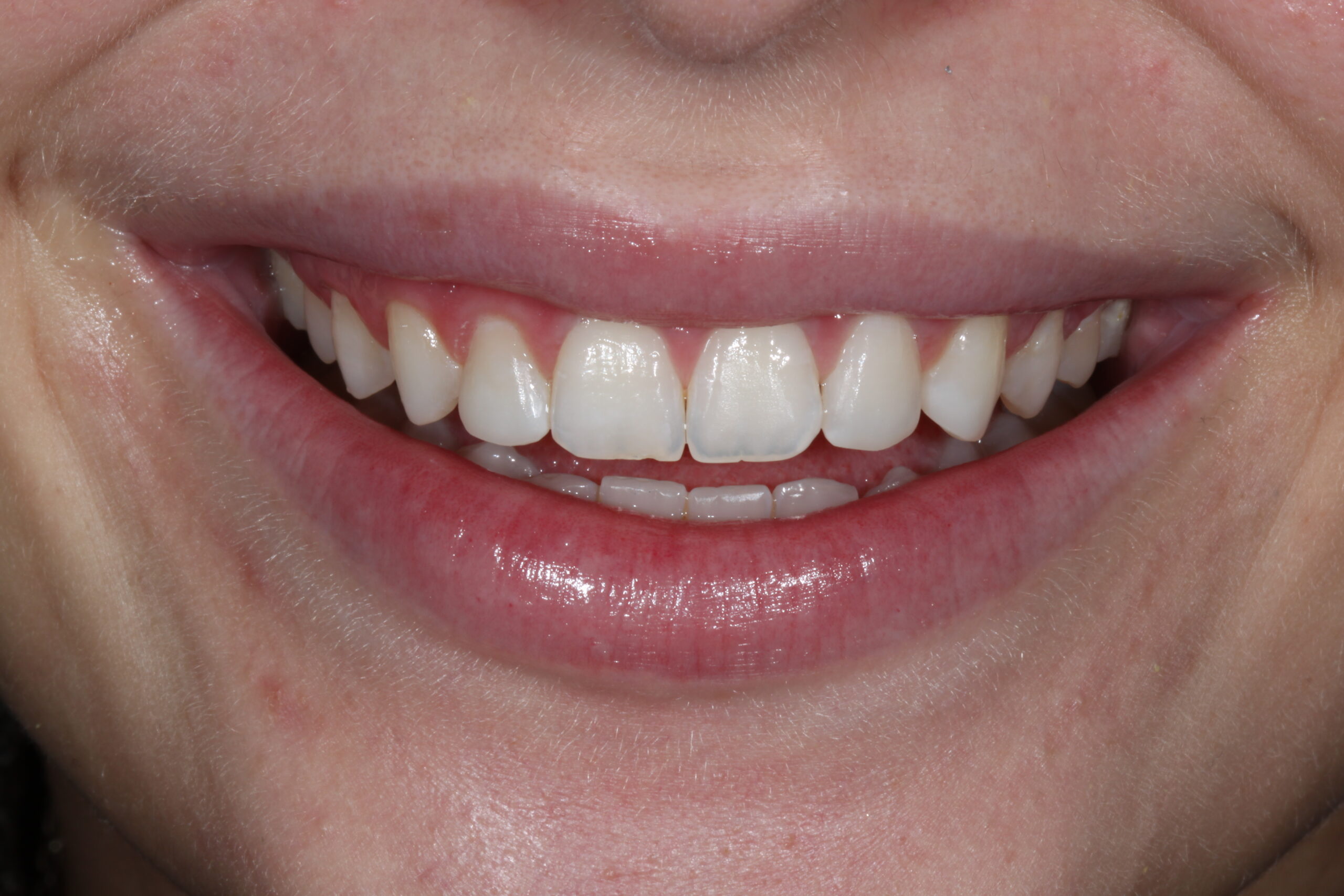 Verifying patient’s satisfaction with her new smile.