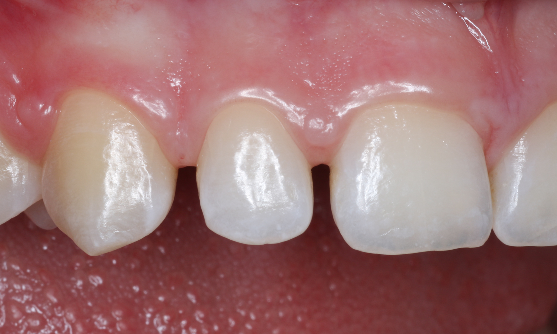 Lateral view of pre-op intraoral situation. 1st quadrant detail.