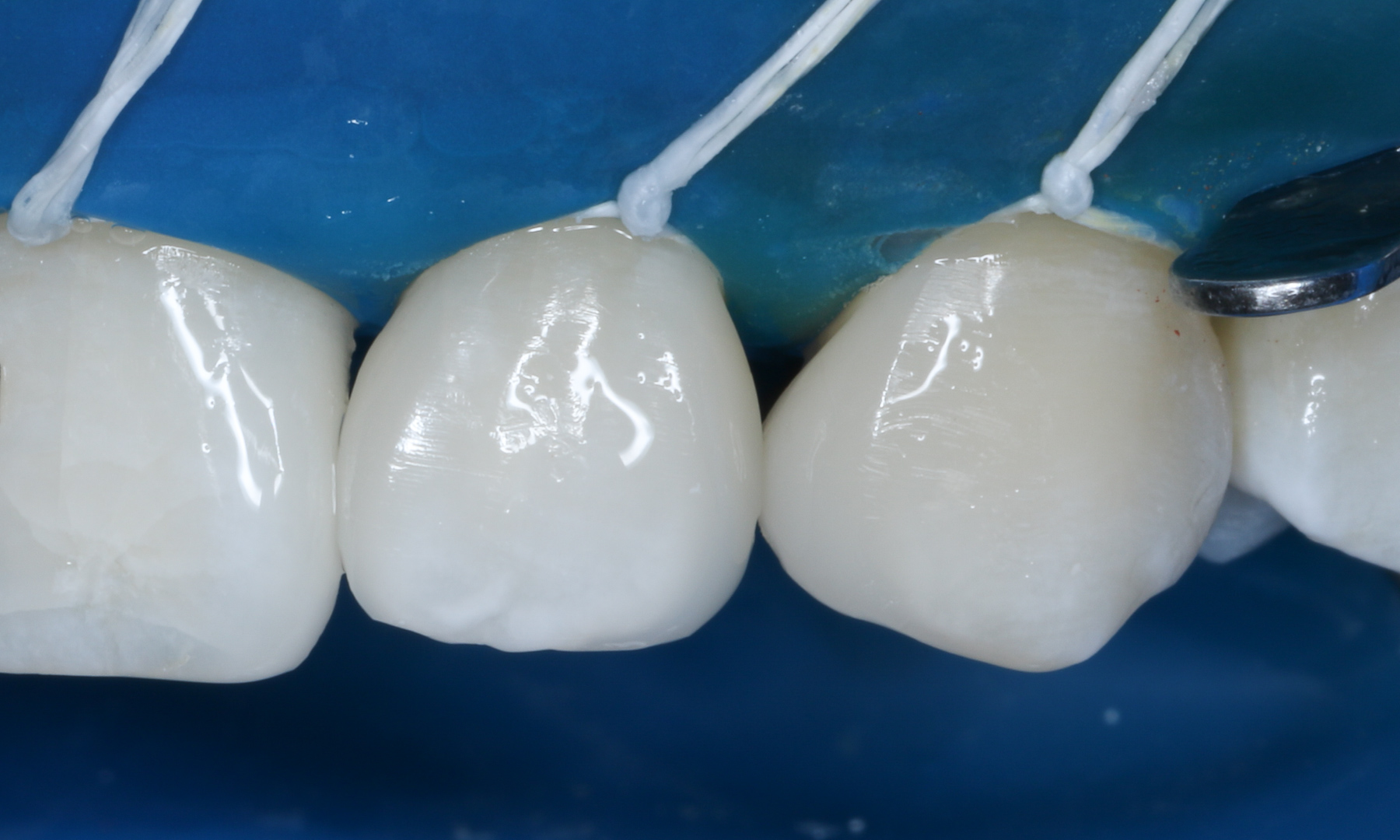 Immediate post-op situation after diastemas closure in 2nd quadrant. Composite was added to #23 mesial, #22 mesial and distal.