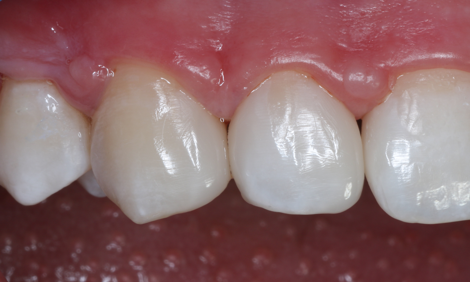 Immediate post-op situation after diastemas closure in 1st quadrant after rubber dam removal.