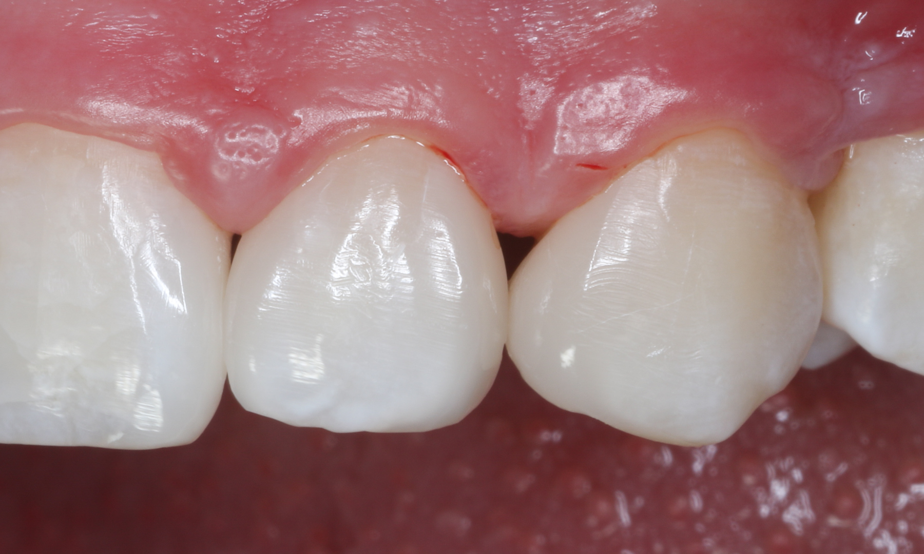 Immediate post-op situation after diastemas closure in 2nd quadrant after rubber dam removal.