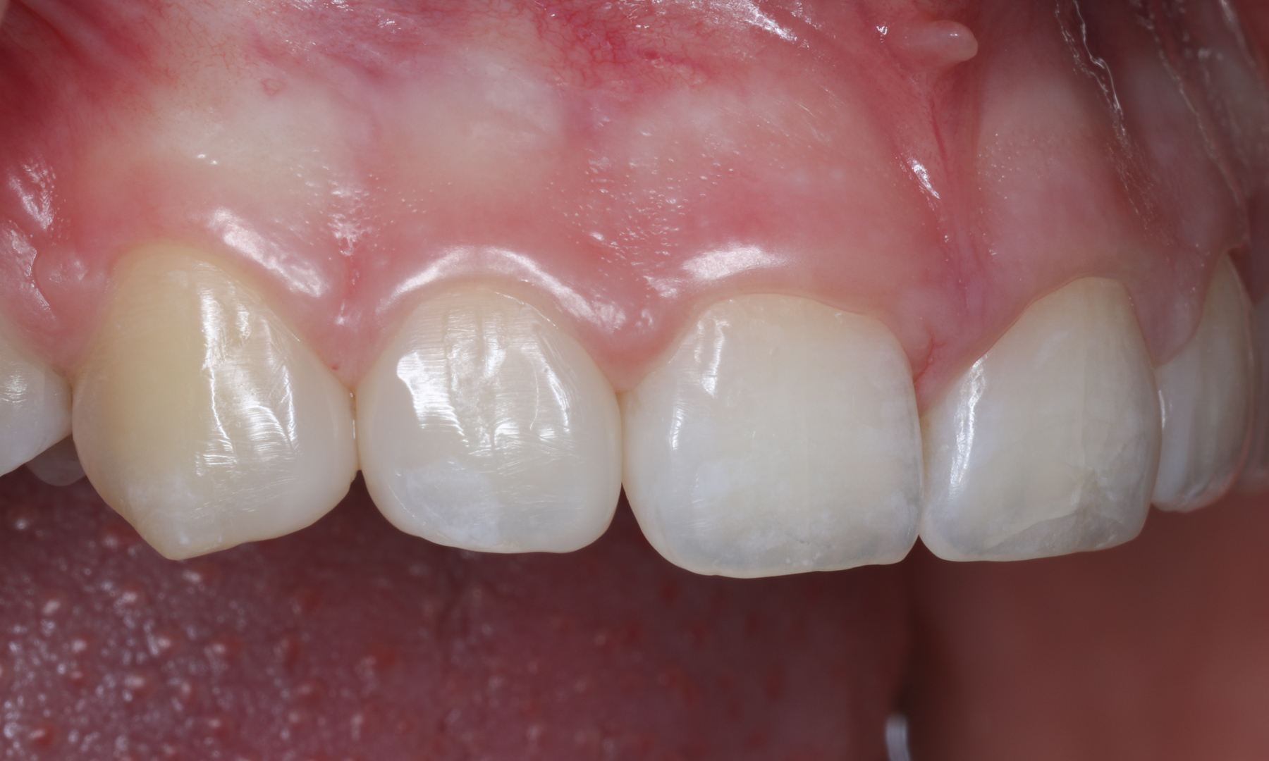 Lateral view of 1 week follow-up intraoral situation. 1st quadrant detail. Notice the closure of black triangles.