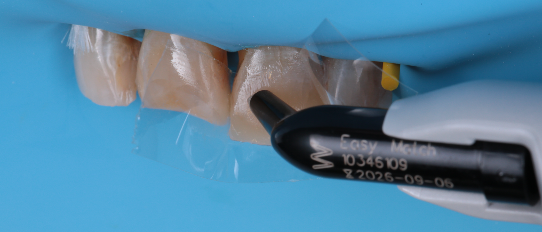 After isolation with mylar strips, Filtek Easy Match Universal Restorative, Warm shade is used to restore the buccal and incisal edges