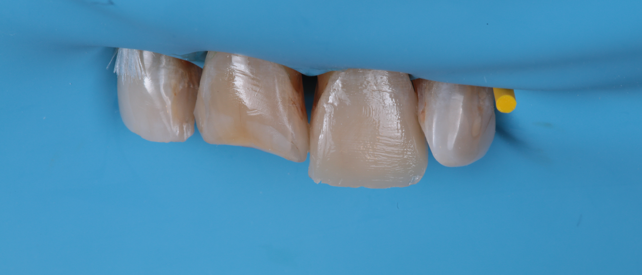 Note the naturally-adaptive opacity on the incisal edge of the restored tooth