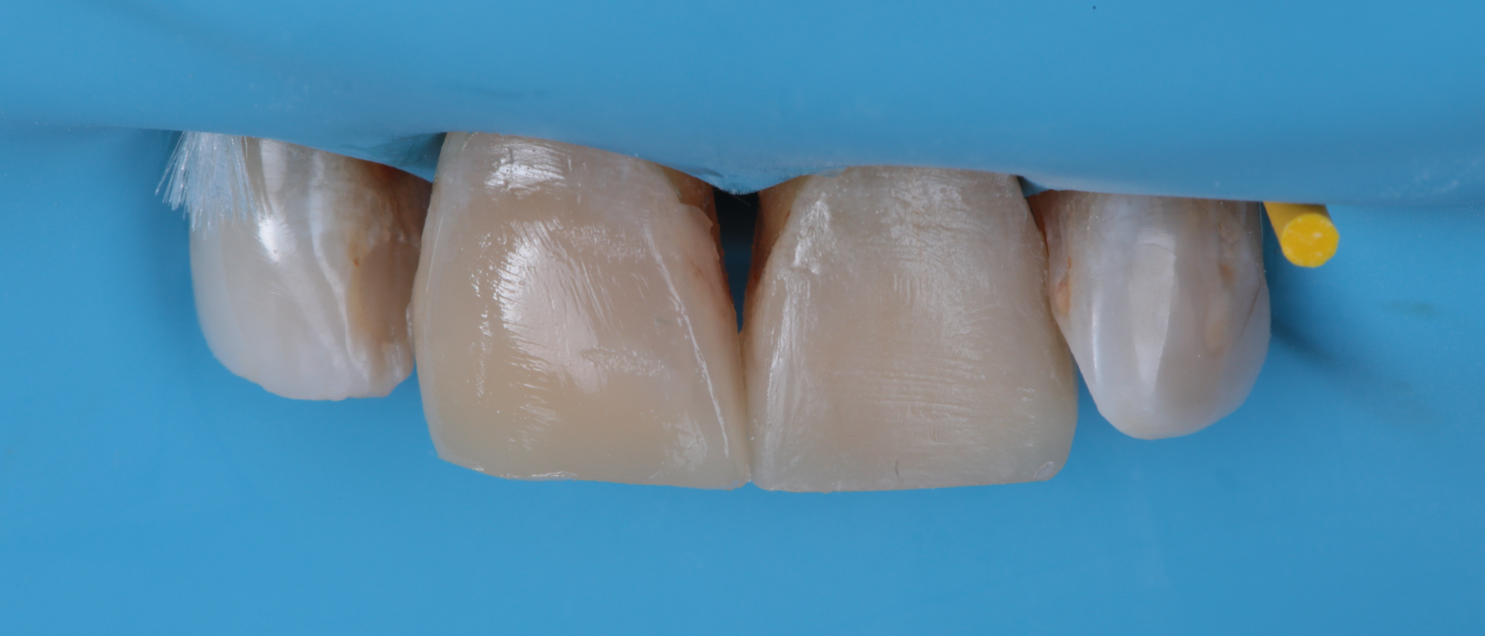 Both centrals restored. Note the opacity gradient that follows the natural appearance