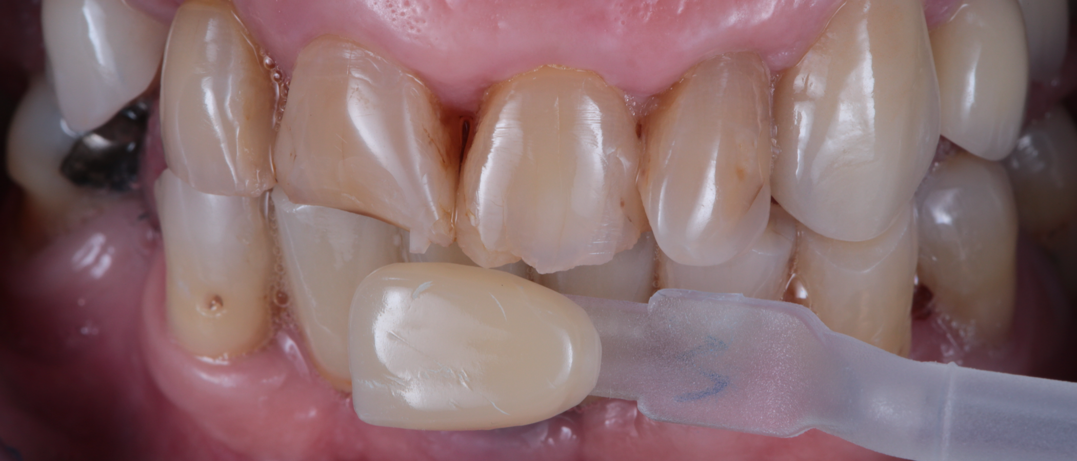 Using a custom shade guide, this patient’s richer tooth shade was determined to match 3M™ Filtek™ Easy Match Universal Restorative, Warm shade