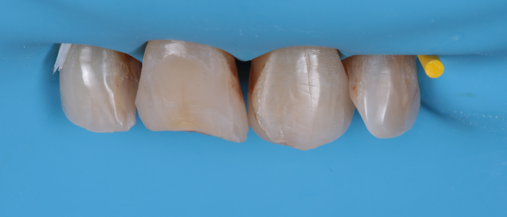 After isolation, teeth were prepared minimally to remove sharp enamel remnants