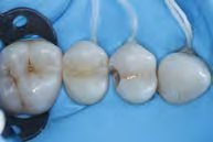 Access to caries lesion.