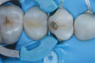 Build-up of distal ridge with 3M™ Filtek™ Universal Restorative.