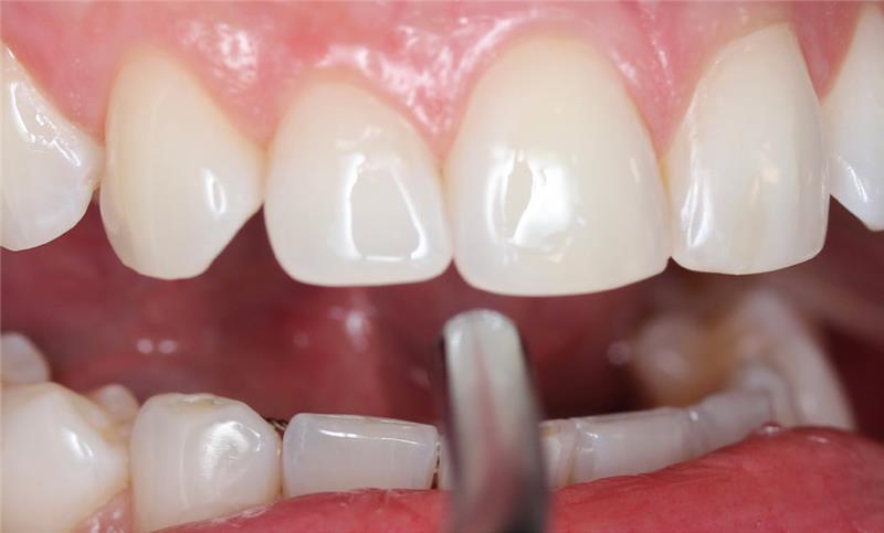 Tooth close-up
