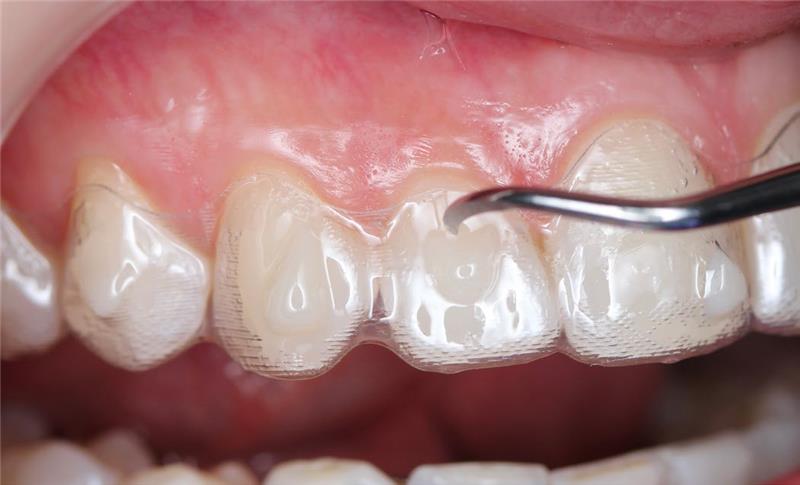 Tooth close-up and aligner