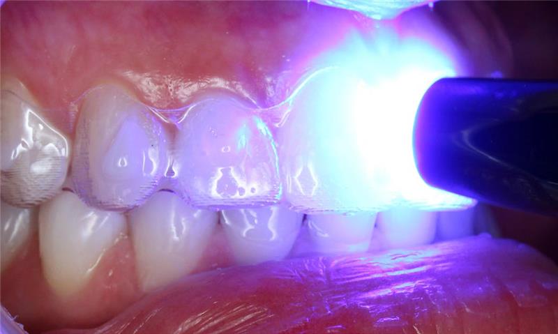 Light suring tooth close-up