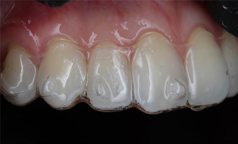 tooth close-up aligner