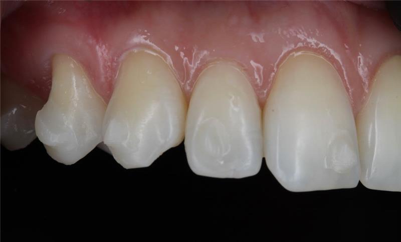 Tooth close-up
