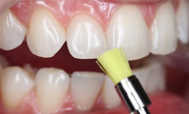 tooth close-up with brush
