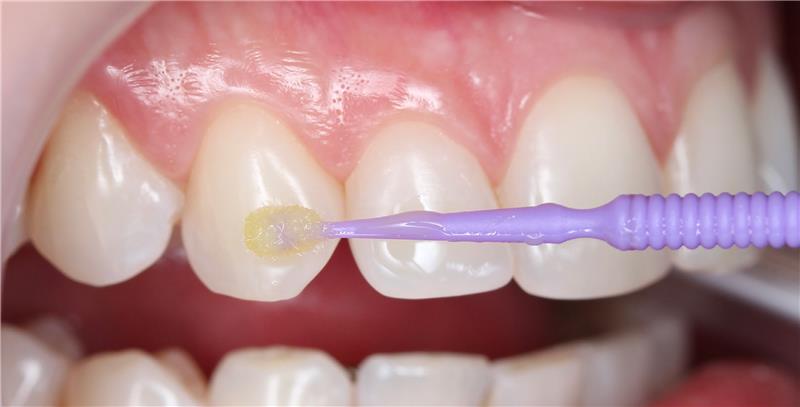 Tooth close-up with brush