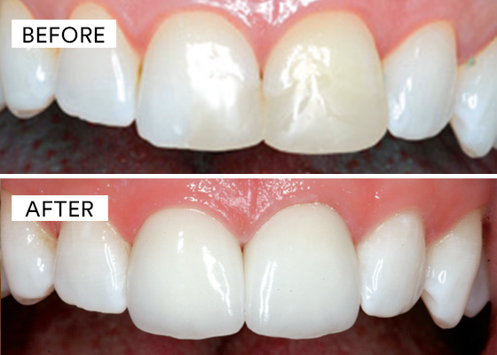 before and after