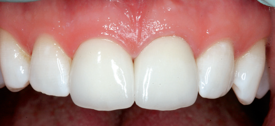 Final result post-cementation