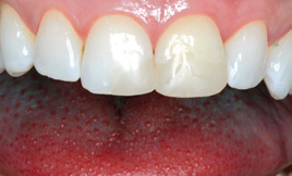 Initial situation, teeth close up, one tooth is darker then the rest