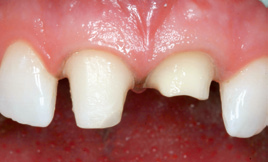 close up of tooth stumps