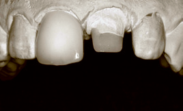 Tooth model with teeth and tooth stump
