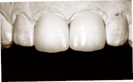 Final restorations on stone model of teeth