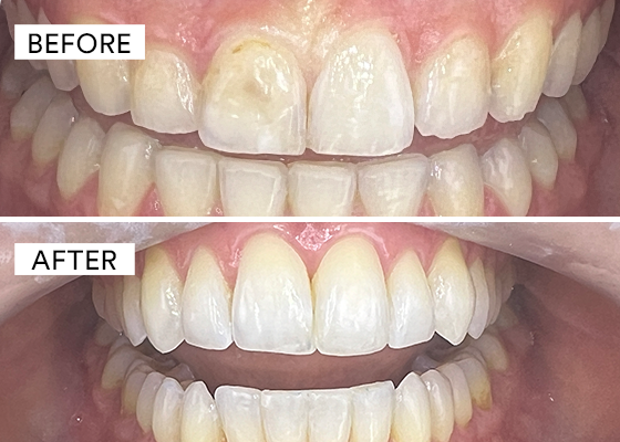 before and after