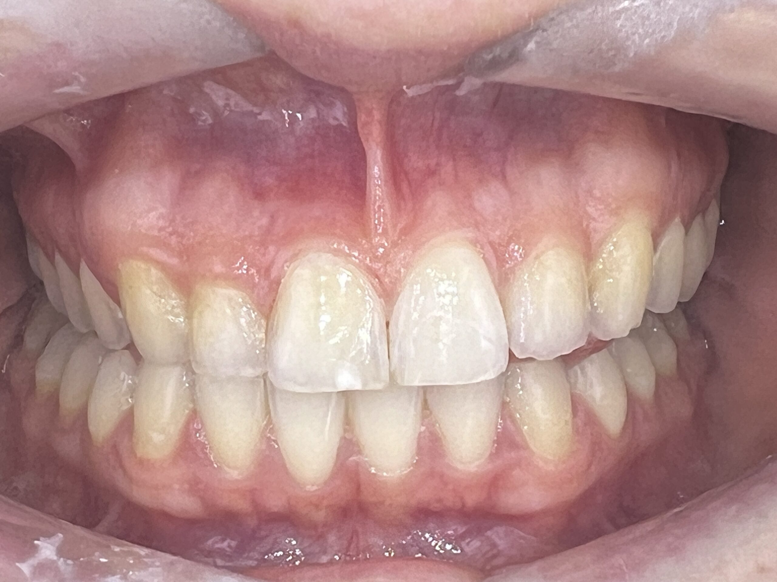 Clinical situation after. Natural shade