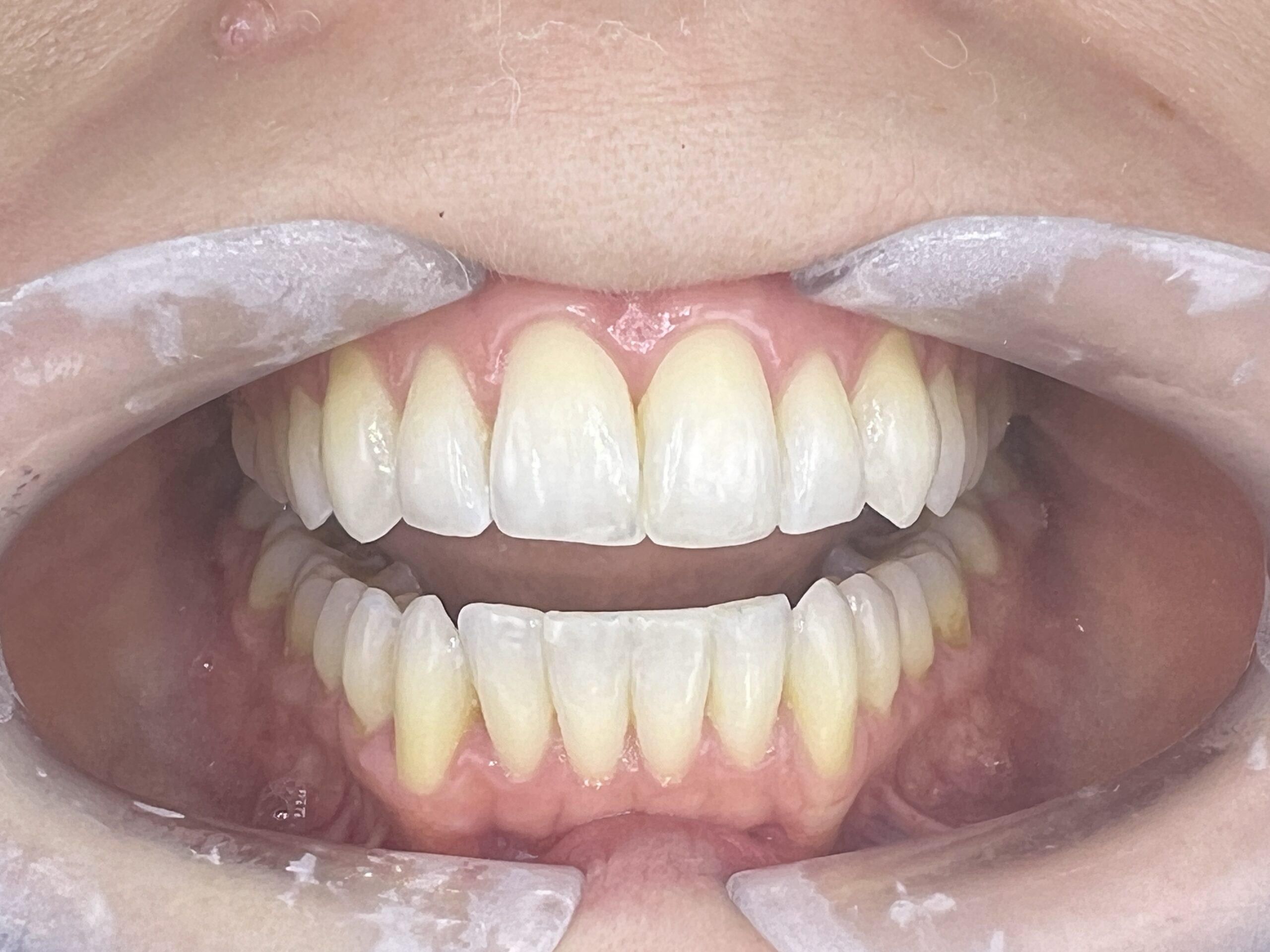Clinical situation after. Bright shade in teeth 12 and Natural in 13 and 23