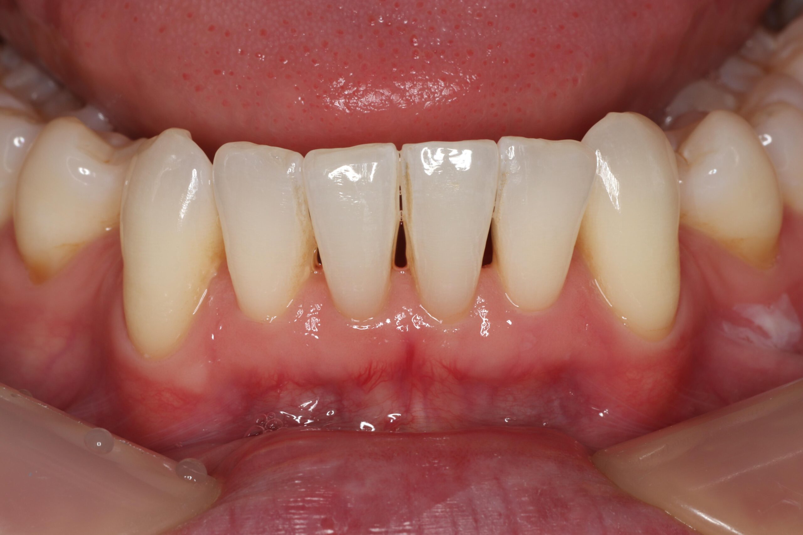 Pre treatment of lower black triangles following orthodontic treatment