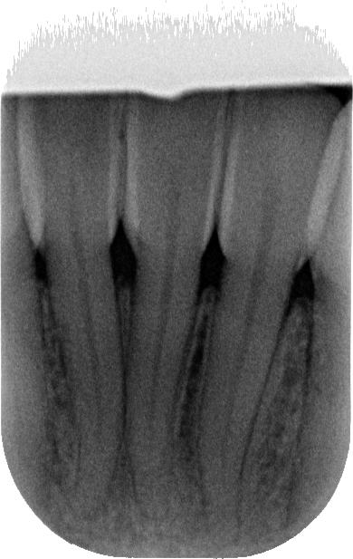 Periapical radiographs taken after treatment demonstrate the classic Bioclear shape achieved with the matrices, as well as smooth, overhang-free emergence profiles.