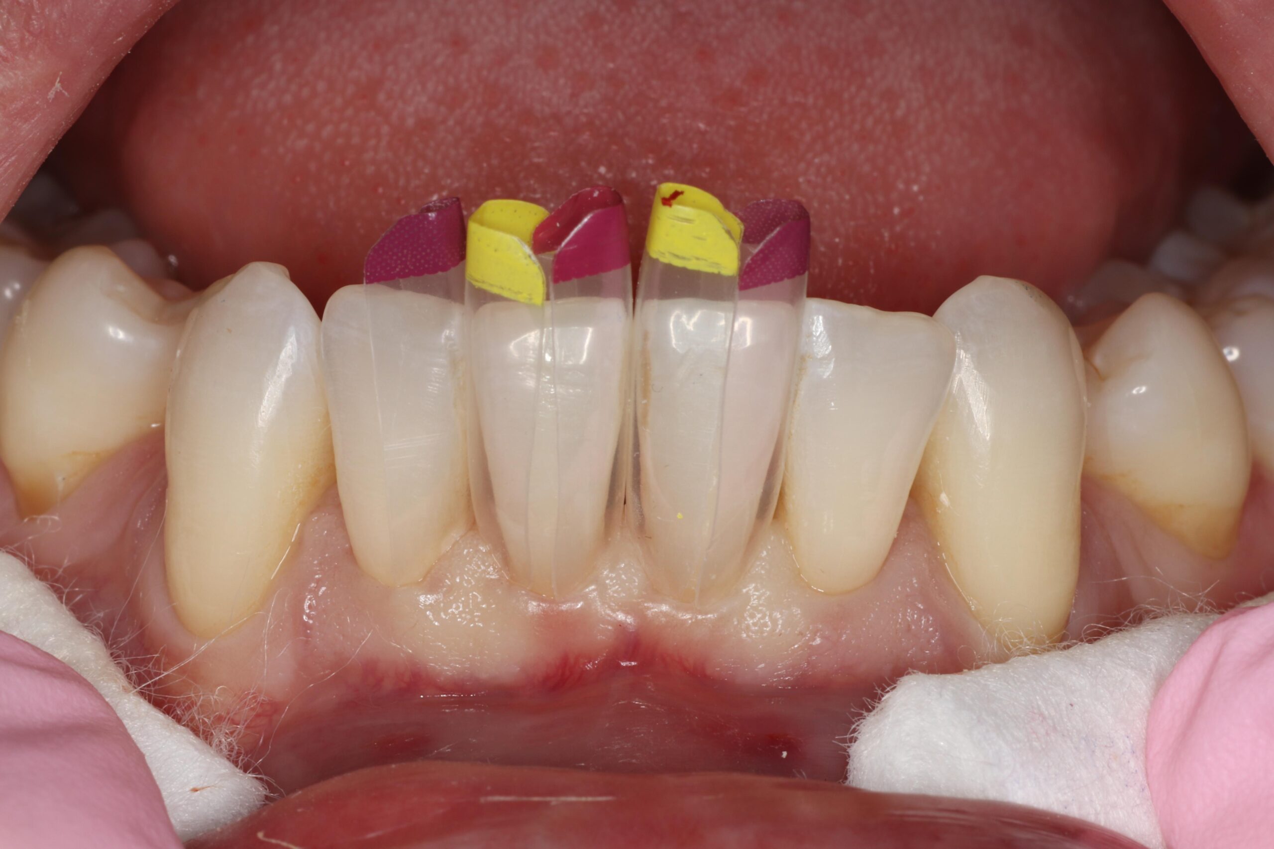 Anatomical black Triangle mylar Bioclear matrices were selected, and tried in to ensure the proper emergence profile with the surrounding gingiva and papillae