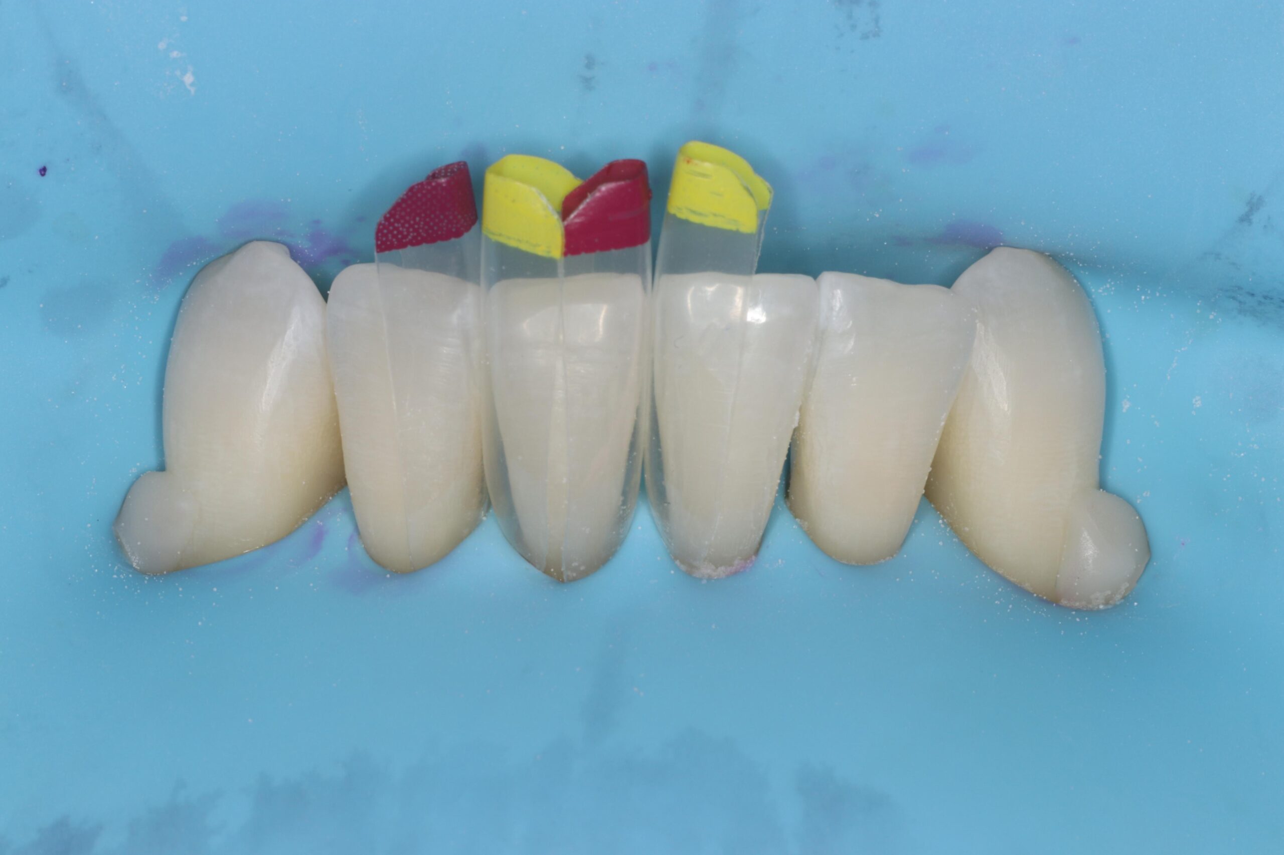 Small Black Triangle matrices were positioned on the first tooth both mesially and distally. Shield matrices were placed on adjacent teeth to protect the surrounding spaces