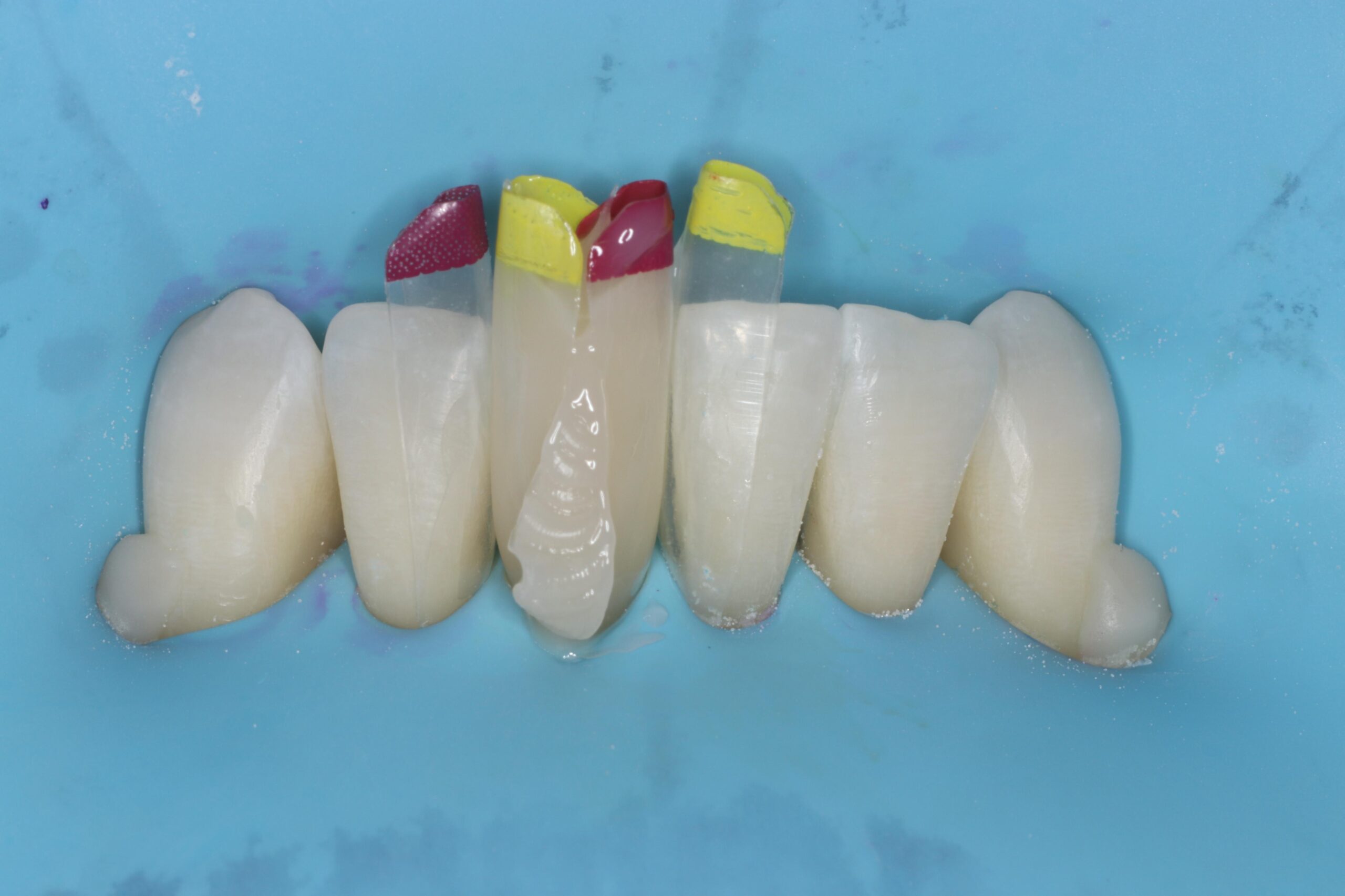 Bioclear Injection Moulding was performed using 3M Scotchbond Universal Plus, warmed 3M Filtek Supreme Flowable, and 3M Filtek Supreme XTE body paste composite in shade A2