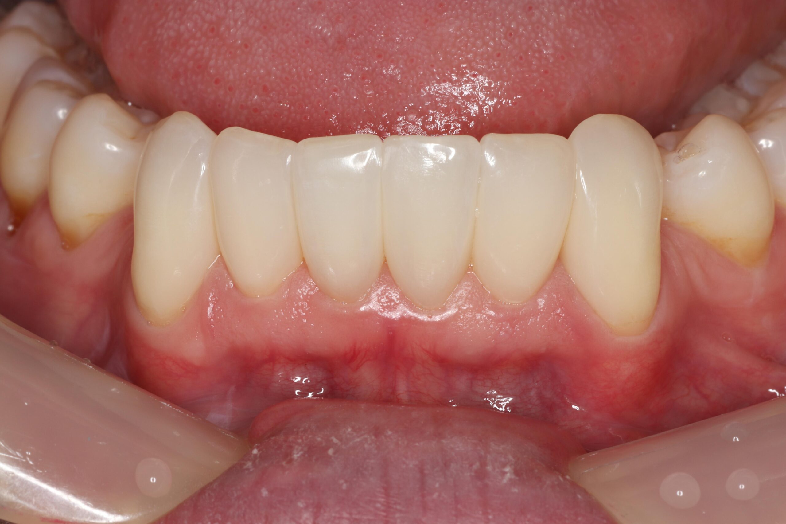 Post treatment photo highlighting the elimination of the visible black triangles. These images demonstrate durable restorations with a flawless polish and healthy surrounding periodontal tissue.
