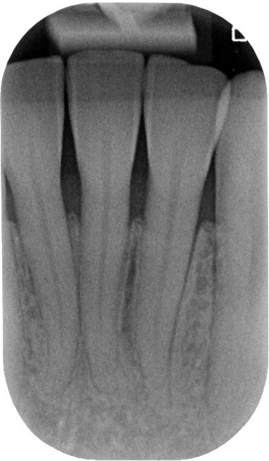 Periapical radiographs taken before treatment demonstrate the black triangle spaces