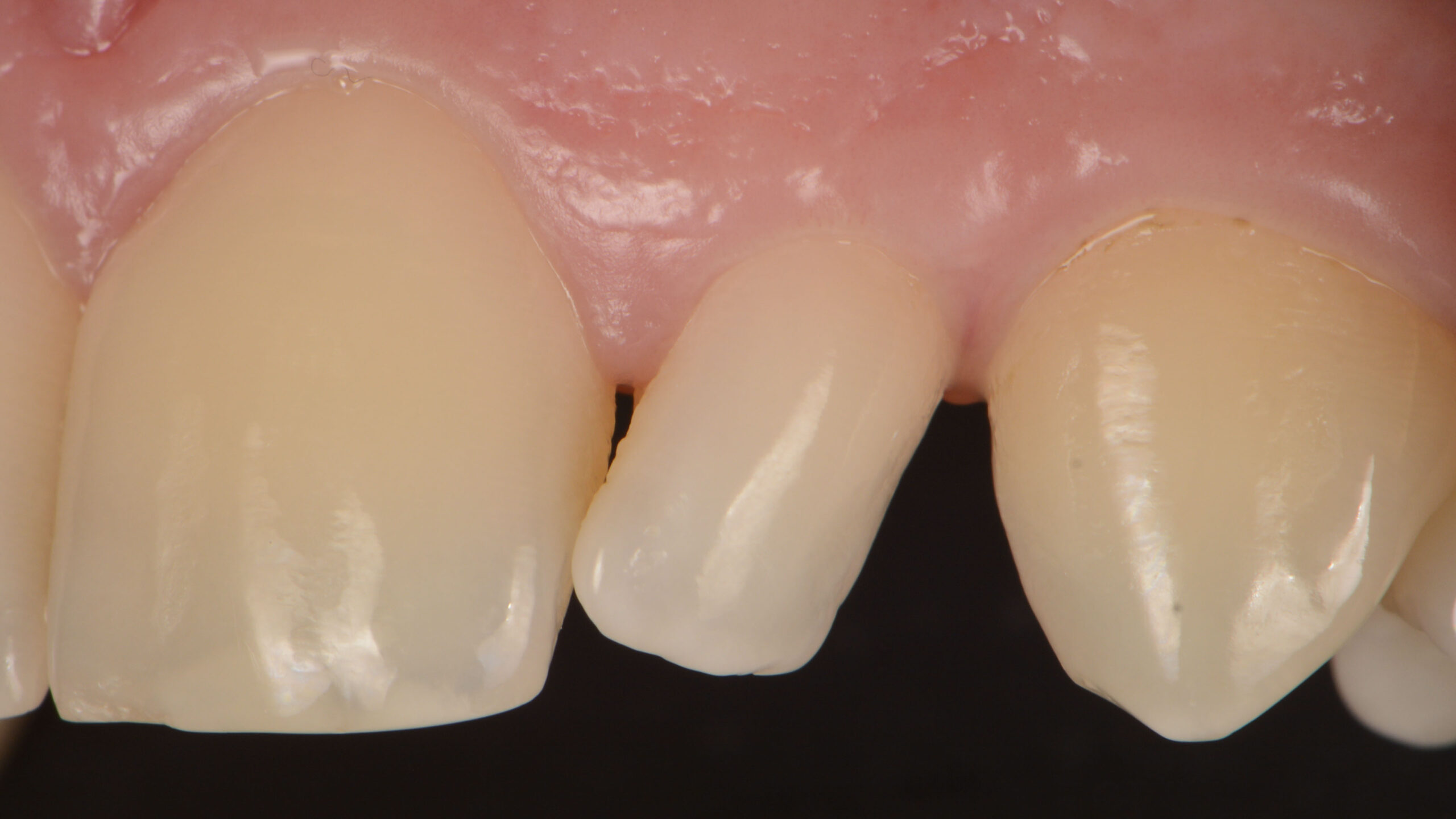 Teeth close up, the middle one is very cricket