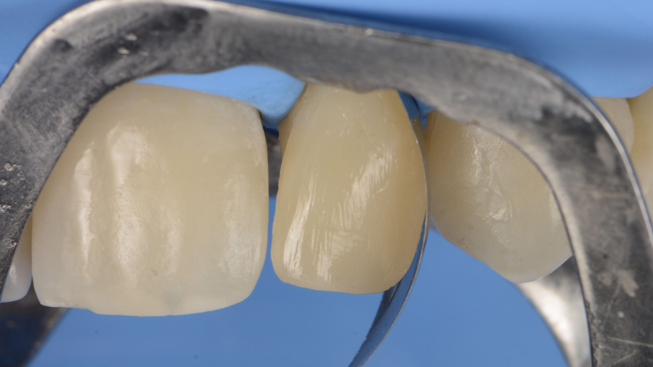 Using a sectional matrix, the distal wall and contact point with the canine is created