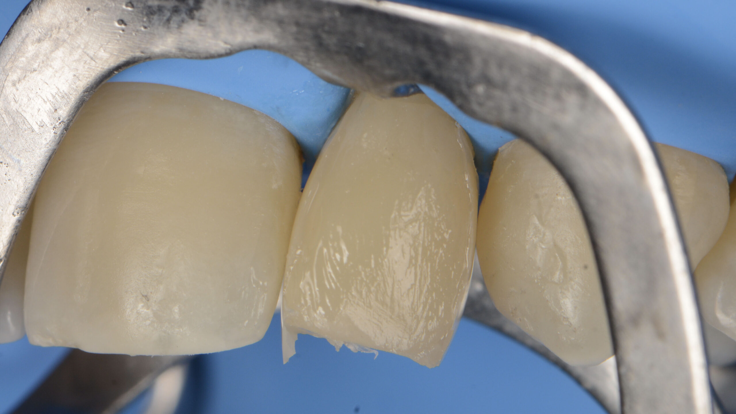 After the general contours are defined, and contact points established, the restoration is ready for finishing and polishing
