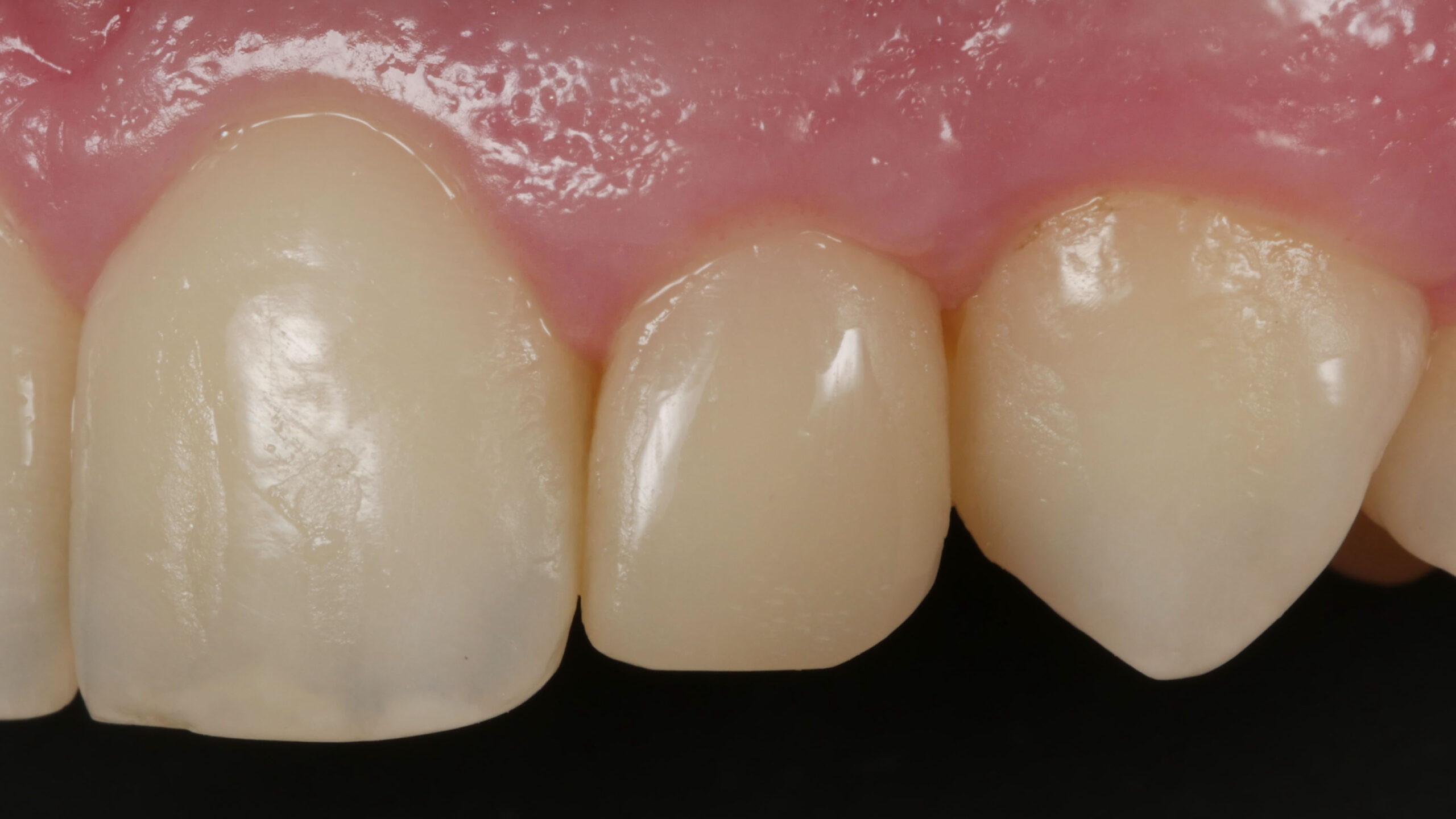 Teeth close-up final appearance, after finishing and polishing, as well as gingival healing