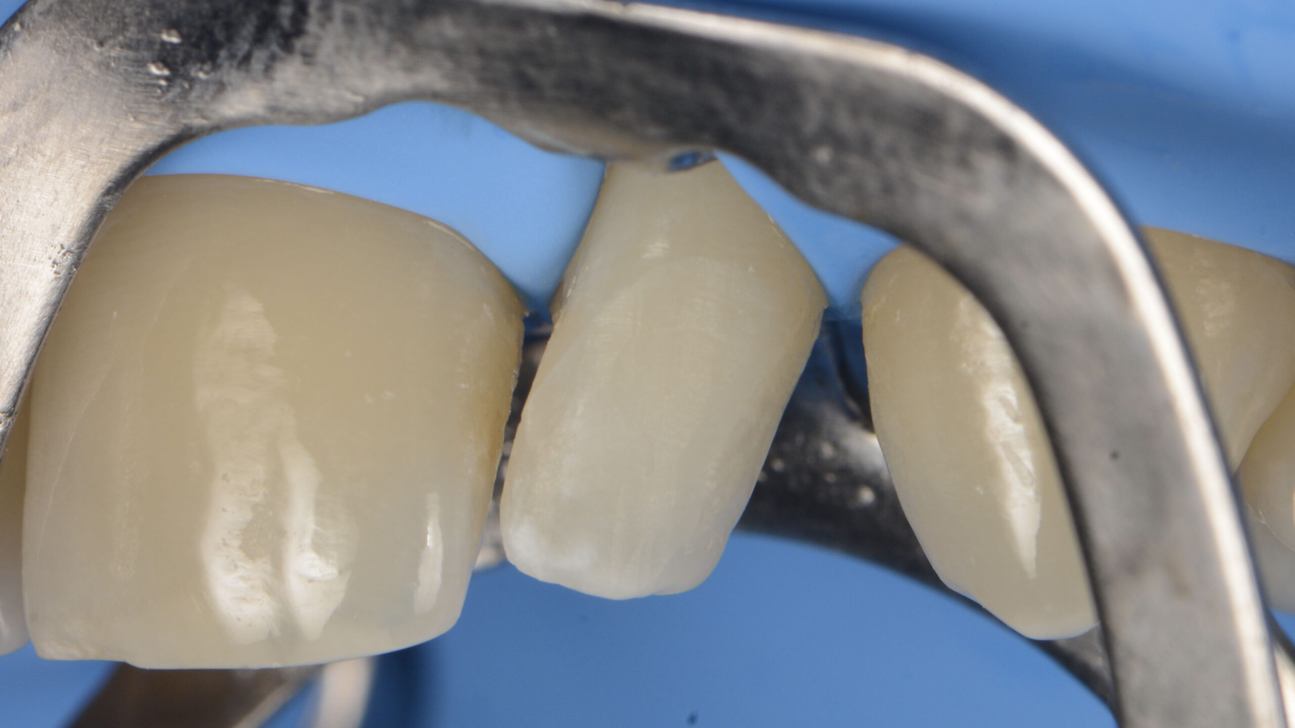 The cricket tooth is prepared for the procedure