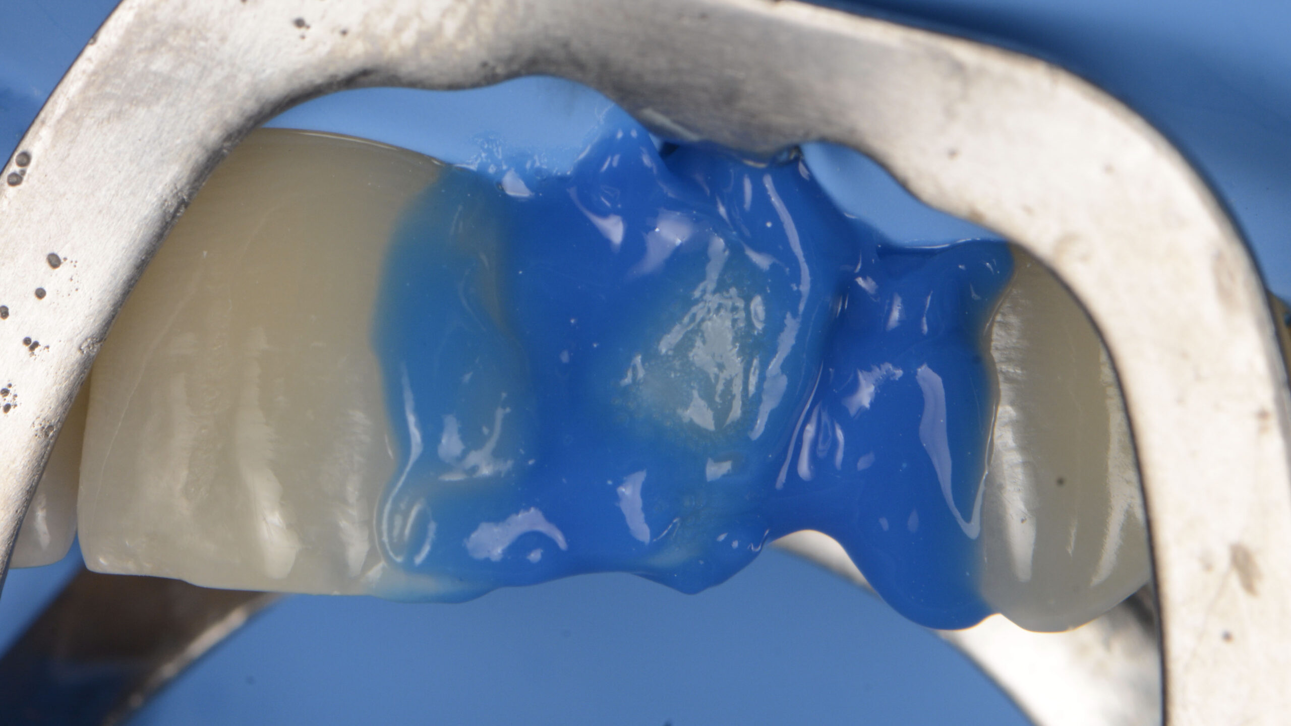 Teeth close-up with blue on it