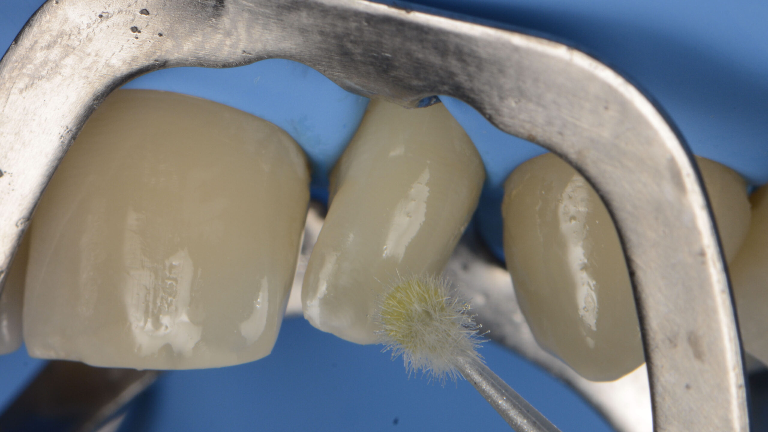 Teeth close-up with a small appication tool