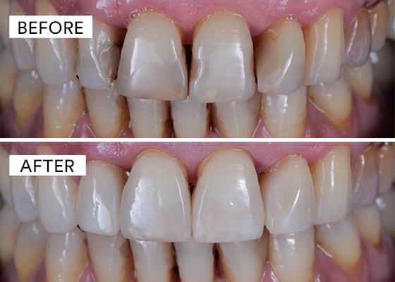 before and after