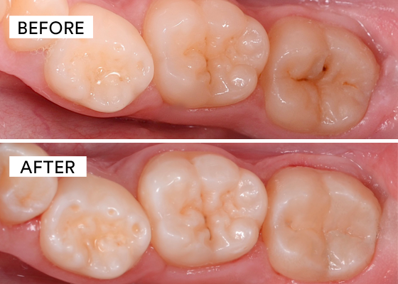 before and after